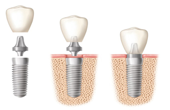 Dental Implants Boynton Beach florida