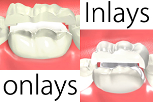 Difference Between Dental Inlays and Onlays