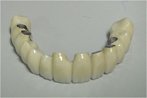 The image shows a single tooth with a visible root canal, placed against a plain background.