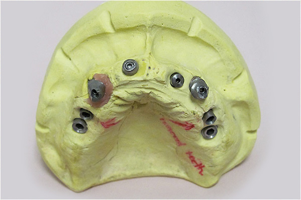 The image shows a close-up of a yellow dental impression tray with multiple holes for fitting teeth, placed on a surface against a light background.