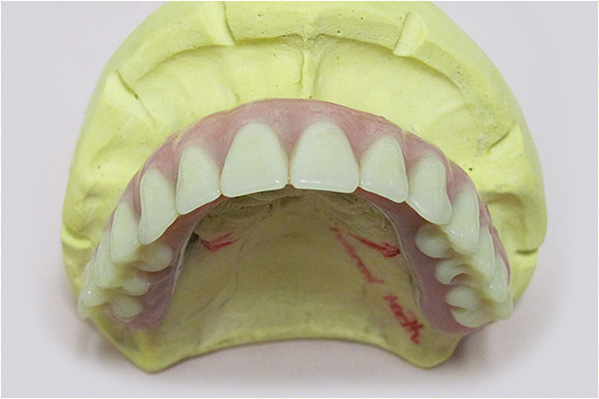 The image shows a model of a human mouth with teeth and gums, placed against a plain background.