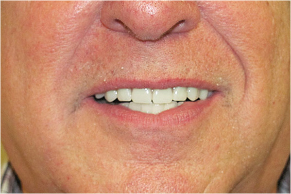 The image shows a man with a wide smile, displaying his teeth and gums, against a neutral background.