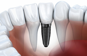 Dental Implants Boynton Beach Florida