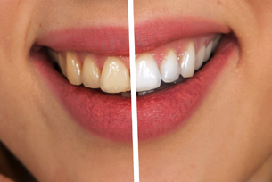 7 Advantages of Teeth Whitening Treatment | Boynton Beach
