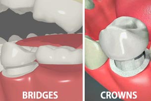 Difference Between Dental Bridges and Crowns