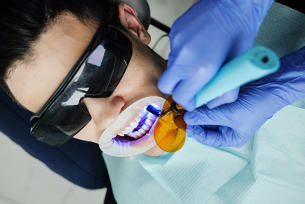 Teeth Whitening With Dental Crowns & Fillings